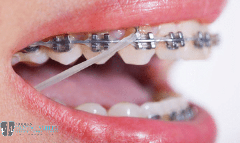 Elastics and Braces