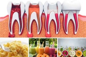 best foods to eat after root canal treatment